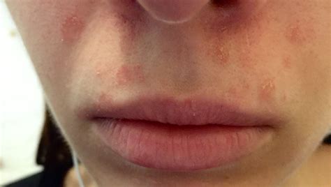 Red Blotchy Rash On Lips | Lipstutorial.org
