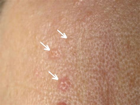 Sebaceous Hyperplasia Forehead