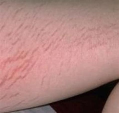 Stretch Marks On Inner Thighs Teenager