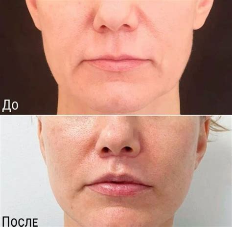 Булхорн делает лицо привлекательнее и моложе? - Cosmetic-clinic