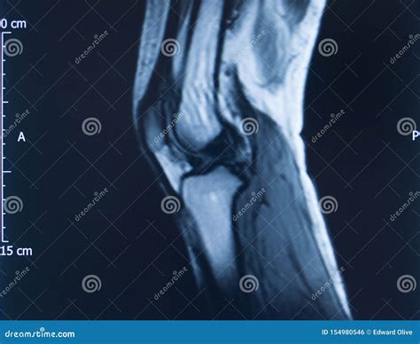 Knee injury mri mcl tear stock photo. Image of joint - 154980546