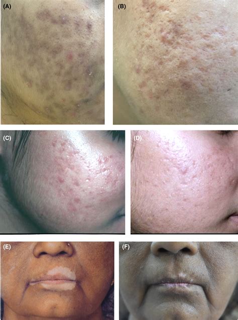 Acne Scars Before And After Chemical Peel