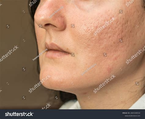 Holes In Skin From Acne