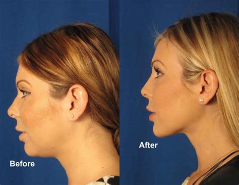 Laser Liposuction Dangers at Milla Stelzer blog