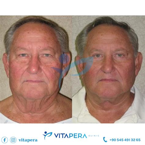 Endoscopic Mid Face Lift in Turkey | Vitapera
