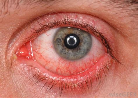 Flash burn eye causes, symptoms, diagnosis & treatment
