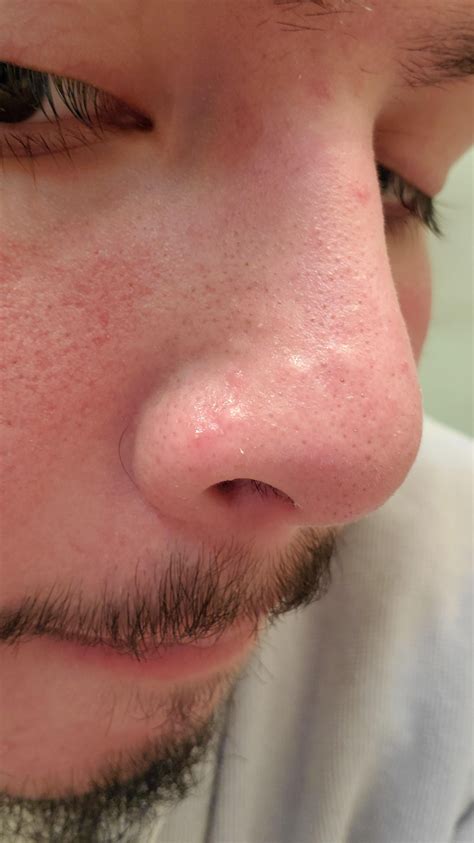 What Are Nose Bumps at Gail Carroll blog