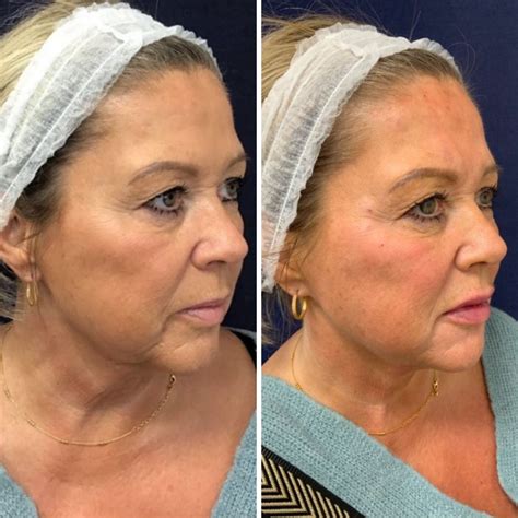 Surgical Face Lift Non Surgical Facelift Treatment