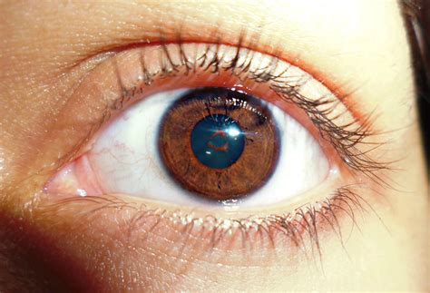 Persistent Pupillary Membrane In Humans My Girlfriend Has Persistent