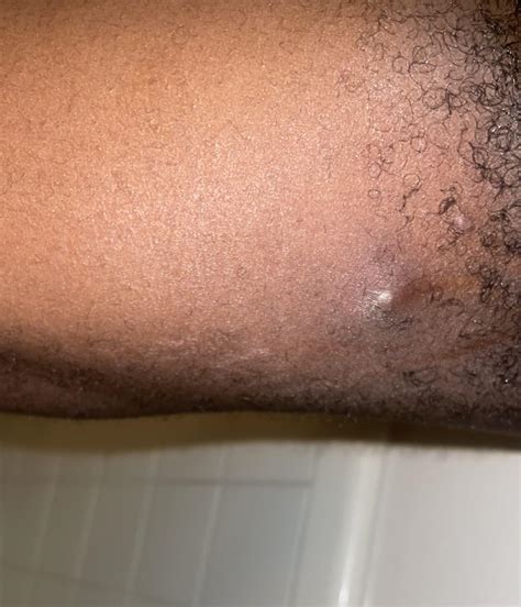 Ingrown Hair On Balls Ingrown Hair Care Ball Bump Care For Bikini Area