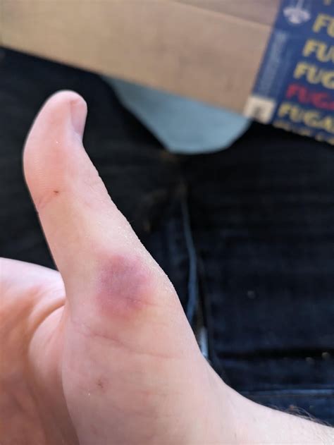 Hand Lesion like bruise. : r/DermatologyQuestions