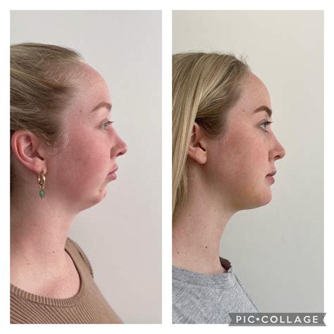 Does mewing work? : r/QOVESStudio