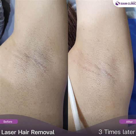Laser Hair Removal Arms