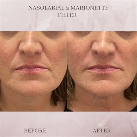 Nasolabial Fold & Marionette Filler - Eluma - Laser & Aesthetics