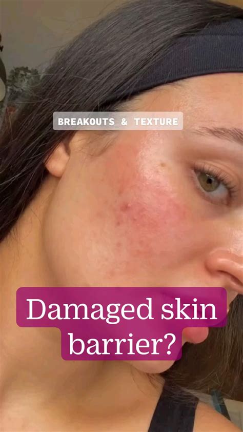 How to repair a damaged skin barrier – Artofit