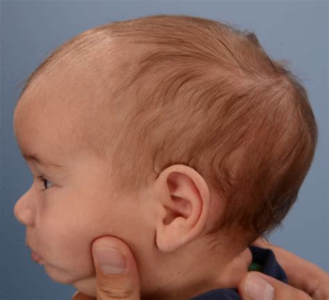 List 100+ Pictures Abnormal Baby Head Shape Pictures Updated