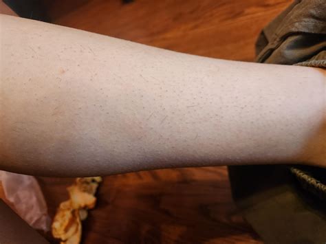 irritated legs full of ingrown hairs. How do i get rid of the and prevent them in the future ...