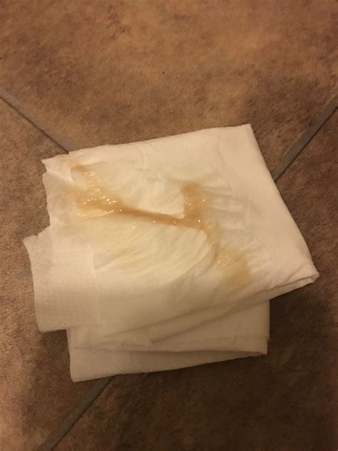 Brown Mucus Discharge