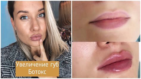 Колят ли в губы ботокс: что такое ботокс, зачем делают эту процедуру ...