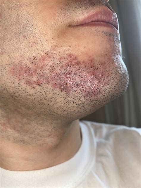Cystic Acne On Chin