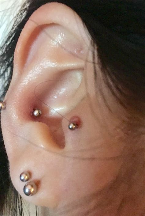 Ear Piercing Keloid Vs Infection at Lucas Oshanassy blog