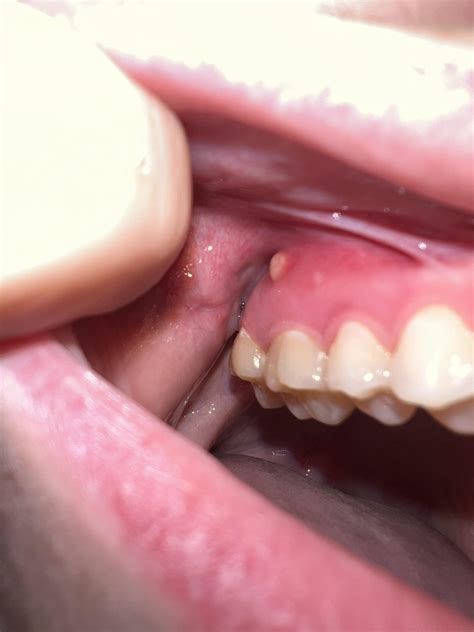 Canker Sore or Gum Boil? : r/askdentists