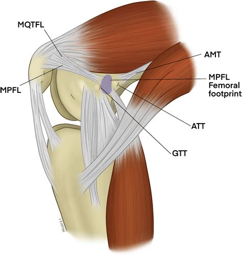 Dynamic–Anatomical Reconstruction of Medial Patellofemoral Ligament in ...