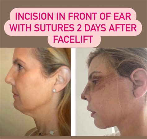 Facelift Scar Revision NYC | Dr. Sam Rizk