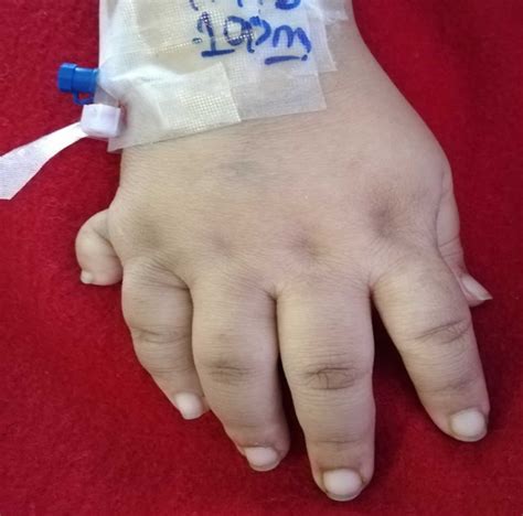 Laurence-Moon-Biedl syndrome, causes, symptoms, diagnosis, treatment & prognosis