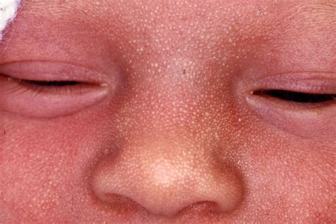 Newborn Rash: Common Rashes and When They're Severe