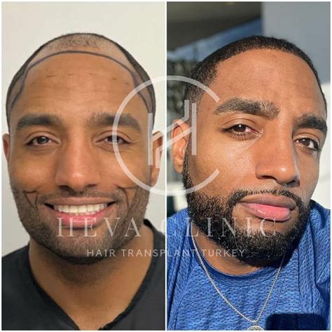 Hair Transplant Before And After