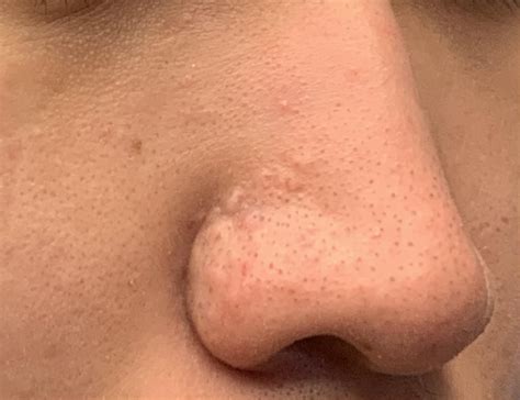 Mysterious bumps on nose for 3+ years! Help! : r/DermatologyQuestions