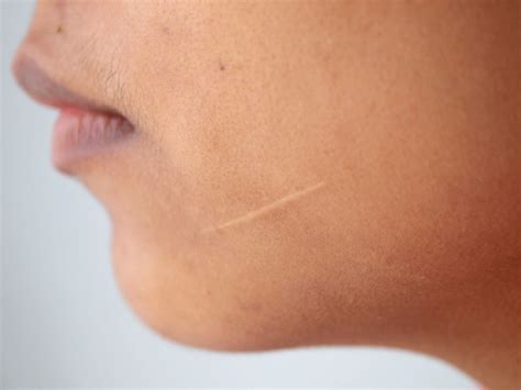 Scars: a natural part of the healing process after injury