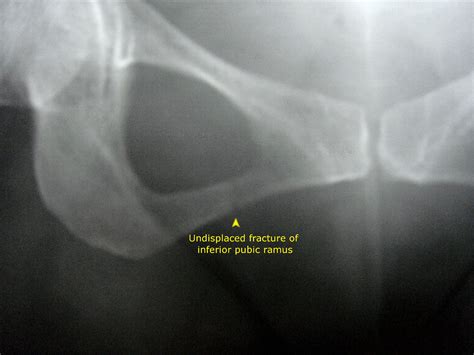 Undisplaced fracture - Inferior pubic ramus « PG Blazer