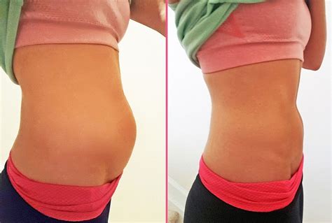 Bloating During ovulation with Gas: Causes, Treatment