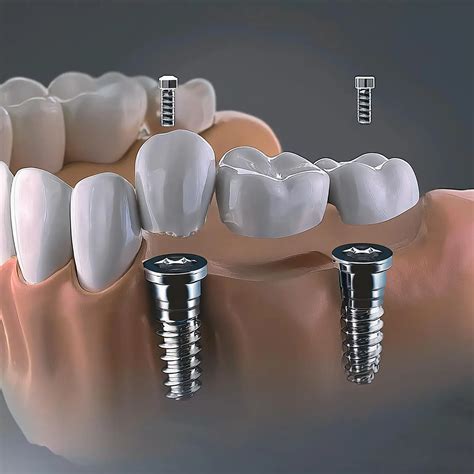 Dental Implant Alternatives: Top 5 Less Invasive Options
