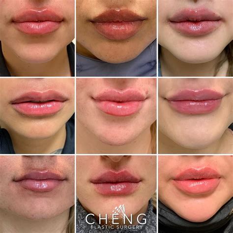 Cheng Plastic Surgery & Medspa on Instagram: “Lip Inspo ⁣ ⁣ Here is just a handful of our ...