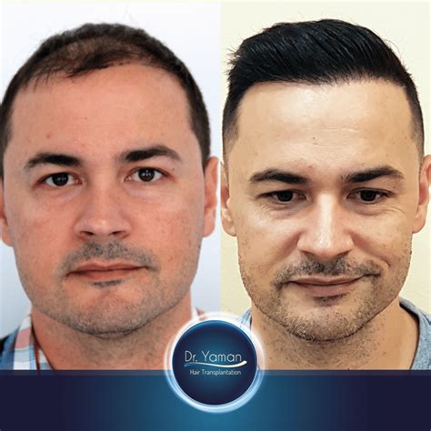 Hair Transplant Cost Turkey | Dr Resul Yaman Hair Clinic