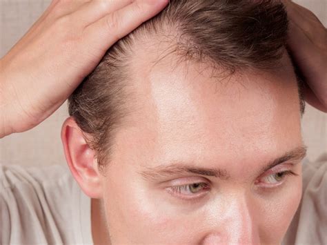 Mature Hairline vs Receding: Know the Nuances