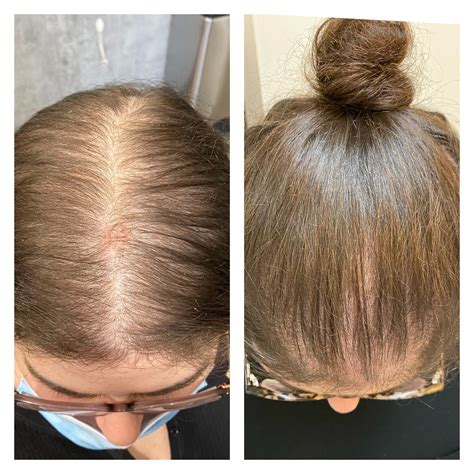 Exosome Treatment for Hair Loss Beverly Hills, CA | Raffi Hovsepian, MD