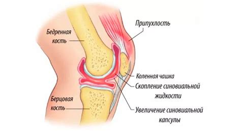 Жидкость в коленном суставе (выпот). Диагностика и лечение