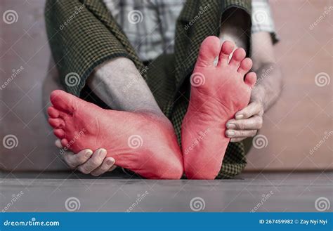 Tingling and Burning Sensation in Foot of Asian Man. Foot Pain. Sensory Neuropathy Problems ...