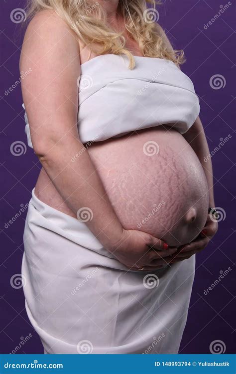 Stretch Marks of the Skin of the Abdomen during Pregnancy. Big Belly ...