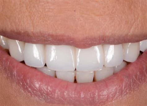 Gum Abscess Popped? Thinking of Popping It Yourself?