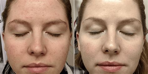 Blue Light Therapy Before and After: Photos, Results & Timeline | LED Esthetics