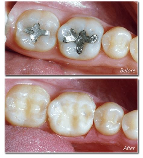 Silver Cavity Filling