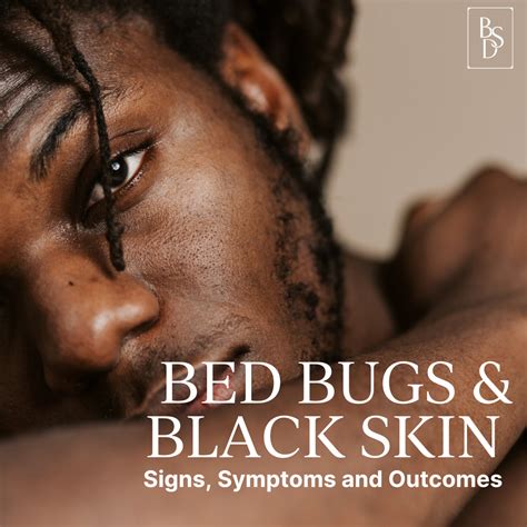 Bed Bug Bites On Black Babies