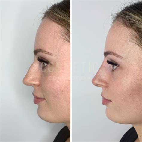 Non-Surgical Nose Job Explained - Cosmetic Connection