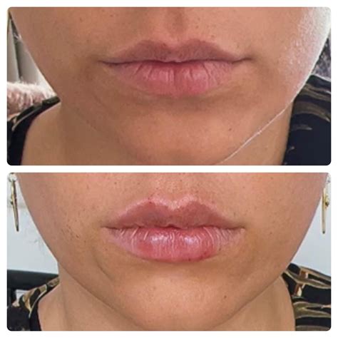 Lip Filler Before and After: Real Results That Will Wow You! - Collective Aesthetics™ - Miramar ...