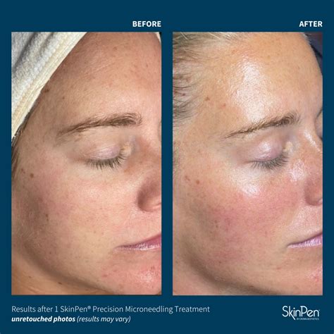 SkinPen Microneedling in Winston-Salem, NC - MyHealth1st